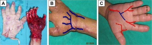 Figure 2 Total hand skin degloving injury.