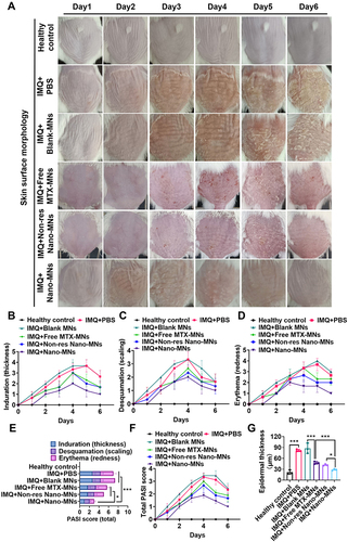 Figure 8 Skin morphology and PASI score in psoriatic mouse model after Nano-MNs treatment. (A) The appearance and morphology of skin from day 1 to day 6. Healthy mice were used as the control. (B-F) Induration, desquamation, erythema and total PASI scores of the back skin. (G) Analysis of the thickness of the epidermal layer of mouse back skin in H&E staining sections. *P<0.05 and ***P<0.001, One-Way ANOVA test.