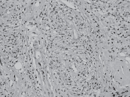 Figure 2 Histopathological examination of lacrimal gland: lymphoplasmacytoid infiltrate with perivascular granulomas (hematoxylineosin, 40×).