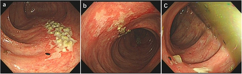 Figure 3 (a–c) Ulcers were present in the transverse colon, and shallow ulcers was seen in the descending colon.