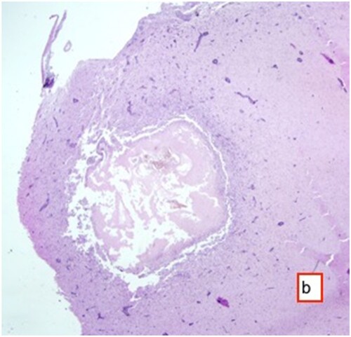 Figure 6. Mononuclear cell infiltrations in and around necrotic areas, HE ×25.