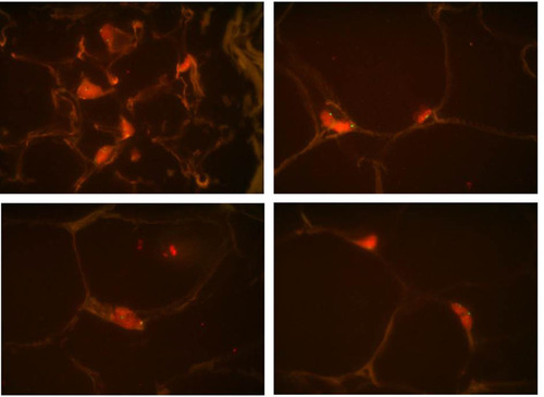 Figure 4 Lipoma with a negative MDM2/CEP12 FISH assay (MDM2-red signals and CEP12-green signals).