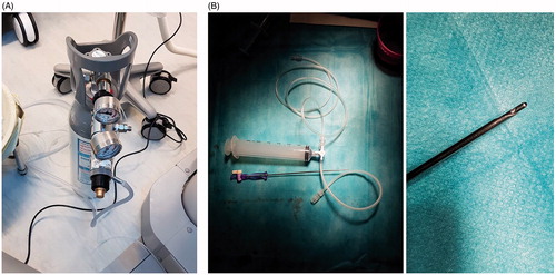 Figure 1. Pictures of a bottle of medical quality CO2 (A) and of Veress needle connected with 60 ml syringe through a 3-way tap (B left) with zoomed view on the extremity of Veress needle (B right).