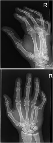Figure 2. X-ray of the right hand during the examination at the ED.