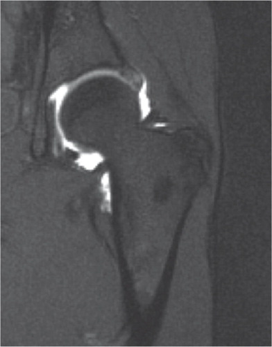 Figure 4. Coronal section MR arthrography of a dysplastic hip. The labrum is hypertrophic and contrast medium is running through the base of the labrum, an indication that the labrum is detached from the acetabular rim.