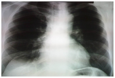 Figure 4 Chest radiograph, demonstrating slightly prominent hilar shadows bilaterally, and normal lung parenchyma (1 year later, during follow-up).