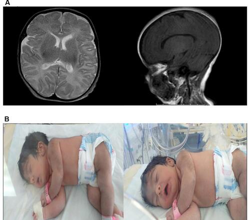 Figure 6 MRI and clinical features of proband II-2 in family F4. (A) Brain MRI; myelination is appropriate for proband’s age. Both thalami, both basal ganglia, corpus callosum, brainstem, cerebellum, and ventricular system appear normal. Central midline structures with no mass effect, no hemorrhage or collection seen. (B) Patient’s characteristic features; soft long ears, U-shaped vermilion of the upper lip, thick skin, hypertrichosis, moderate multiple contractures, hypotonia, and severe hypokinesia.