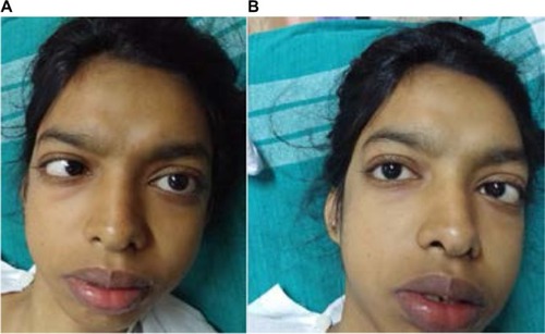 Figure 1 (A and B) Bilateral lateral rectus palsy.