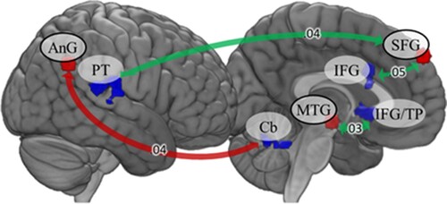 Figure 3. Seed-based functional connectivity during resting state. Red arrows indicate stronger connectivity in the ACE group, green arrows indicate stronger connectivity in the no ACE group. Fisher’s Z is displayed on the arrows. AnG: angular gyrus; Cb: cerebellum; IFG: inferior frontal gyrus; MTG: middle temporal gyrus; PT: planum temporale; SFG: superior frontal gyrus; TP: temporal pole.