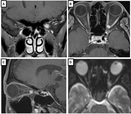 Figure 3 MRI images of a globular tumor of ONSM.