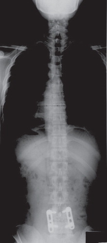 Figure 6. Postoperative plain posteroanterior view of the full spine in upright position revealed bony fusion and improvement of scoliosis.