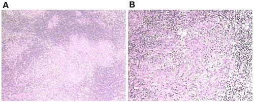Figure 2 (A and B) pathological examination of H&E staining (H&E, 100×; H&E, 400×) from the cervical lymph nodes suggested granulomatous inflammation. Granulomas is composed of epithelioid cells in the lymph nodes. PAS(-).