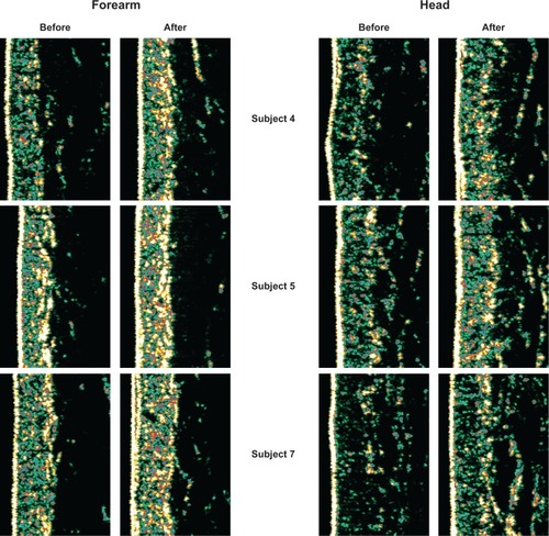 Figure 5 Examples of collagen density measurements in the left ventral forearm and in the crow’s feet area around the left eye in 3 different subjects.