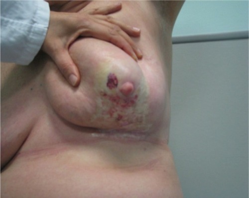 Figure 3 The picture shows a severely retracted and distorted breast with edema of the subcutaneous tissues as well as induration in the central part over the nipple area with peripheral telangiectasias.