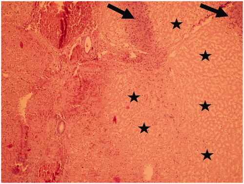 Figure 7. Histopathological analysis image (H-E staining) from Scenario B at 650 V demonstrating extensive necrosis (asterisk, right part of the image) surrounded by inflammatory cells (arrows). An uninjured bile duct and liver vein are visible in the right part of the image.