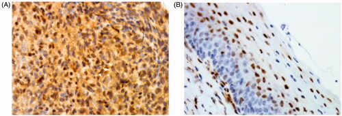 Figure 1. Immunohistochemical staining for p27. (A) p27 showing strong cytoplasmic and nuclear immunopositivity in NPC tissues (original magnification: ×400). (B) p27 showing cytoplasmic negativity in nasopharyngeal mucosal tissues (original magnification: ×400).