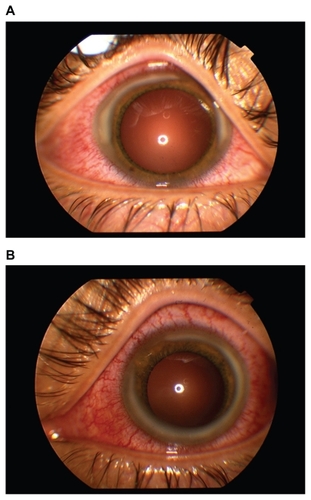 Figure 1 External photographs of the right (A) and left (B) eyes, showing marked conjunctival injection and extensive peripheral corneal infiltrates.