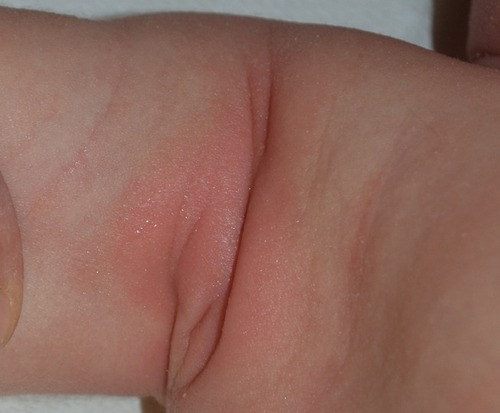 Figure 3 Inverse psoriasis of the right axilla in an infant: minimal erythematosus patch.