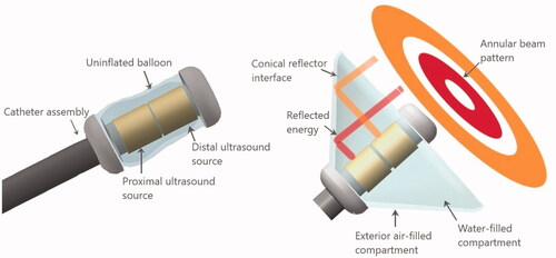 Figure 1. Design schema for the deployable conical ultrasound hyperthermia applicator, consisting of two tubular ultrasound source transducers positioned at the distal end of the catheter, surrounded by a distensible two-compartment balloon, shown in (a) compact profile with the balloon in a collapsed state for device delivery, (b) expanded profile for thermal therapy after positioning at the target site, with the interior compartment filled with water and the outer thin compartment filled with air forming a reflective boundary that directs the ultrasound energy in the forward direction forming an annular beam pattern.