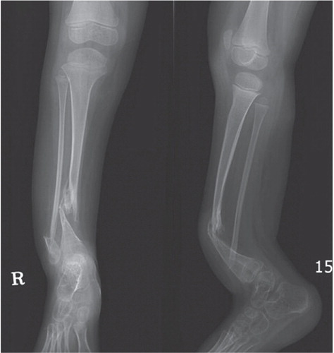 Figure 2. A. Anteroposterior and lateral radiographs from an 8-year-old boy with Boyd type-I congenital pseudoarthrosis of the tibia who was operated multiple times with Ilizarov apparatus and attempted four-in-one fusion. At presentation, the child had frank non-union with sclerotic bone ends with 2.5 cm shortening.