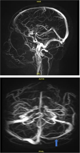 Figure 1 Magnetic Resonance Venography of this patient. There was a reduction in the caliber of the left transverse sinus and the right sigmoid sinus (blue arrow).