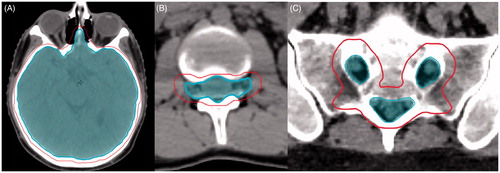 Figure 1. (A) Brain CTV and PTV at level of cribiform plate. CTV excludes intraconal optic nerves and globes. (B) Thecal sac CTV and PTV at level of lumbar spine. CTV includes nerve roots out to lateral edge of the vertebral body. (C) Thecal sac CTV and PTV at level of sacrum. Inner contours represent CTV. Outer contours represent PTV.