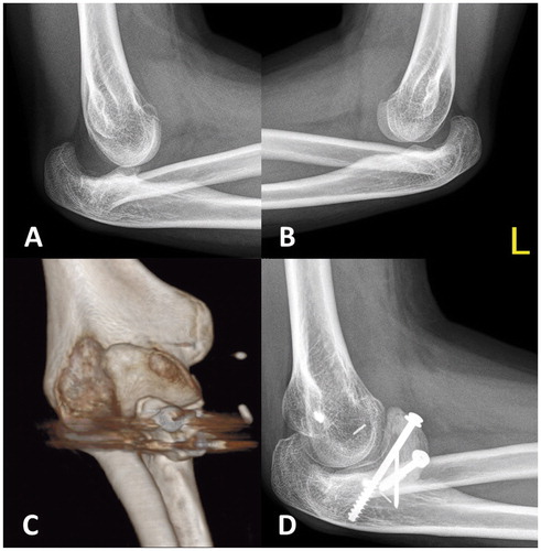 Figure 2. At age 17. A and B. Progredient posterior dislocation in both elbows. C. The postoperative 3D CT-scan shows the reconstructed anterior elbow buttress. D. At the latest follow-up 12 months after surgery, with full consolidation of the graft and a well-reduced elbow joint.