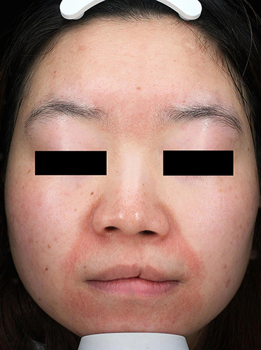 Figure 1 Facial image of the PD patient. Erythema and papules can be seen around the wing of nose and mouth without scales.