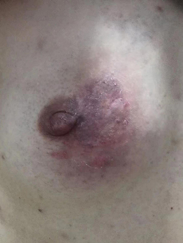 Figure 1 Large scaly erythematous plaque on the right breast.
