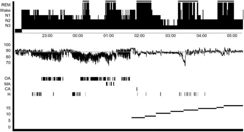 Figure 5 Overnight polysomnogram.