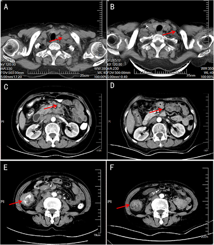 Figure 2 CT showed lymph node enlargement in the left supraclavicular fossa (A), thickening of the right colon wall with multiple metastatic lymph nodes in the abdomen (C and E). After conversion treatment, the enlarged lymph nodes (B and D) and primary tumor (F) were significantly reduced.