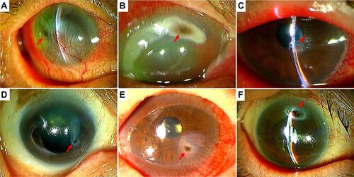 Figure 1 Slit lamp photographs of the perforated cornea in the 6 patients. Slit lamp photographs (A–F) show the corneal perforations in cases 1–6, respectively. All perforations occurred in the right eye. Red arrows indicate the area of corneal perforation. (A) Prior perforated area central to the inferonasal cornea with opacification and neovascularization are shown. A new perforation is observed temporal to that opacification, resulting in flattening of the anterior chamber. (B) Peripheral corneal thinning is apparent in the temporal to superior area with oval perforation in the superior area where the iris is incarcerated. The Anterior chamber is severely inflamed, with flare and severe hyperemia. (C) A small corneal perforation is observed slightly inferonasal to the corneal center. Flattening of the anterior chamber and severe hyperemia are also evident. (D) Peripheral corneal thinning in the inferonasal to temporal area is evident. A small corneal perforation is observed in the inferonasal area. (E) Inferonasal opacification of the cornea and neovascularization due to prior corneal perforation are shown. A perforation with iris fitting is apparent in the same area. (F) An oval perforation is apparent in the superior peripheral cornea. Although therapeutic SCL is applied and iris fitting has occurred, the anterior chamber is very shallow.