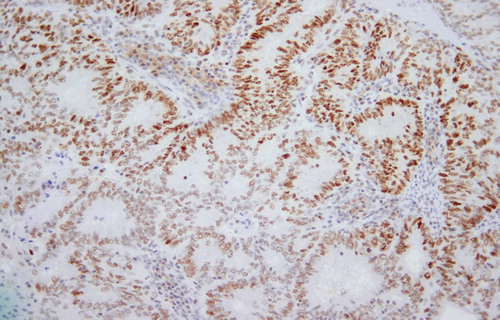 Figure 4: Positive staining of tumour nuclei is demonstrated. 4 μm MSH6 stained section. Original magnification: 200x.