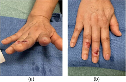 Figure 3. Photograph demonstrating wounds post bedside debridement to the (a) second and third digits and (b) third and fourth digits on day of emergency department presentation.