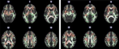 Figure 1. White matter maps of differences between nonresponders and responders. The figure shows areas of significantly decreased fractional anisotropy in nonresponders when compared with responders, at baseline (A) (P<0.05; Family-Wise Error [FEW]-corrected) and at 1 2-week follow-up (B) (P<0.05; FWE-corrected). Fractional anisotropy white matter skeleton is represented by green voxels displayed on a background image that corresponds to the mean fractional anisotropy image in standard Montreal Neurological Institute (MNI) MNI152 brain space (radiological view), with the coordinate number on top. Red-yellow voxels represent regions in which the fractional anisotropy was significantly lower in the nonresponder group relative to the responder group. From reference 33: Reis Marques TR, Taylor H, Chaddock CA, et al White matter integrity as predictor of response to treatment in first episode psychosis. Brain. 2014;137:172-182. © 2013, Oxford University Press.