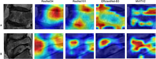 Figure 4 Grad-CAM images of different DL models: (A) a SM image, (B) a STB image.