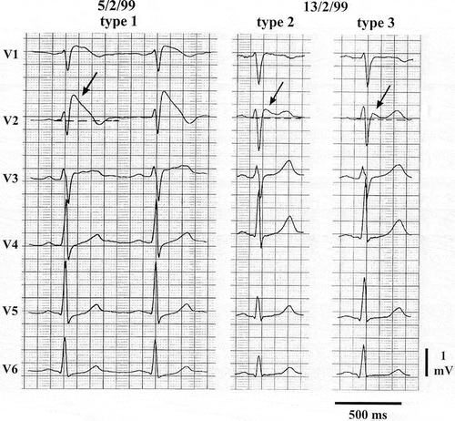 Figure 2. EKG of a patient with Brugada syndrome with three characteristic patterns. The left panel shows a type 1 ECG, whereas the middle and right panels show type 2 and 3 ECGs.