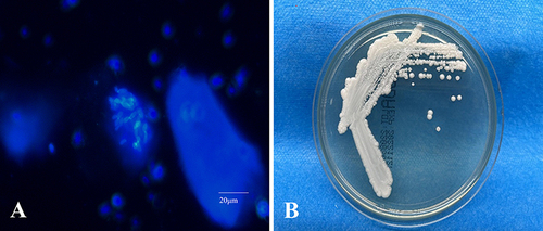 Figure 4 Microscopic examination revealed sub-spherical budding yeast-like cells without pseudohyphae structure (A); Three days later at 27°C, creamy yeastlike colonies appeared on SDA plate (B).