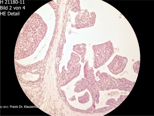 Figure 4 Small and monomorphic nuclei without necrosis.