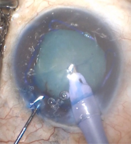 Figure 1 Phaco tip puncturing an intact anterior capsule.
