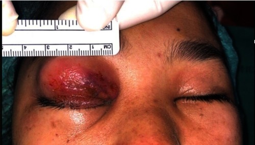 Figure 1 Day 3 marked swelling, erythematous tense right eyelid presented at the first presentation.