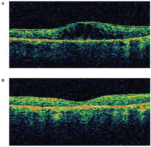 Figure 1 A OCT image of left eye in Patient #3 at baseline. Central subfield thickness was 517 μm and total volume was 9.02 mm3. B OCT image of left eye in Patient #3 after 259 days of nepafenac treatment. Central subfield thickness was 158 μm and total volume was 7.35 mm3.