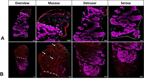 Figure 5 Fluorescence microscopy of the bladder of (A) intravesical doxorubicin (DOX) without hyperthermia (HT) (full dose); (B) intravenous DPPG2-thermosensitive liposomes containing DOX (DPPG2TSL-DOX) with HT (full dose). Red: DOX contained within the tissue; green: cytokeratin filaments of epithelial cells; white: Von-Willebrand-Factor (VWF) within blood vessel walls; and purple: actin filaments in smooth muscle fibres (SMA). White lines mark the transition from mucosa (above the line) to detrusor. The white arrows pointed at red dots show DOX accumulation around the small vessels after DPPG2-TSL-DOX with HT.