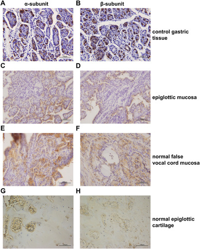 Figure 1 Expression levels of the α- and β-subunits of H+/K+-ATPases (proton pumps) in normal laryngeal tissues as revealed by immunohistochemical staining. (A) Gastric control tissues stained strongly for the α-subunit. (B) Gastric control tissues stained strongly for the α-subunit. (C) The α-subunit was expressed in normal epiglottic mucosa. (D) The α-subunit was expressed in normal epiglottic mucosa. (E) The α-subunit was expressed in normal false vocal cord mucosa. (F) The α-subunit was expressed in normal false vocal cord mucosa. (G) The α-subunit was expressed in normal epiglottic cartilage. (H) The α-subunit was expressed in normal epiglottic cartilage.