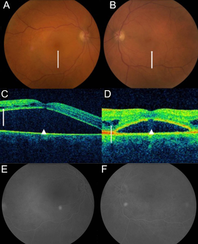 Figure 5 Post-Treatment Fundoscopic Evaluation, Optical Coherence Tomography, and Fluorescein Angiography. (A) (OD) and (B) (OS) were taken 7 months later and demonstrated significant fundoscopic improvement after plasma exchange, systemic therapy, and intravitreal bevacizumab. Her visual acuity improved to 20/50 OS; however, residual macular edema remains (arrows). After systemic treatment and intravitreal bevacizumab, the intraretinal and subretinal fluid improved but did not resolve on repeat OCT 7 months later and explains only partial visual recovery OS ((C) OD; (D) OS). These images suggest that the vision loss was primarily due to an exudative retinopathy such as WM-related SMD rather than CRVO as originally diagnosed. Recent FA shows no evidence of vascular leakage to explain the source of intra- and subretinal fluid ((E) OD; (F) OS).