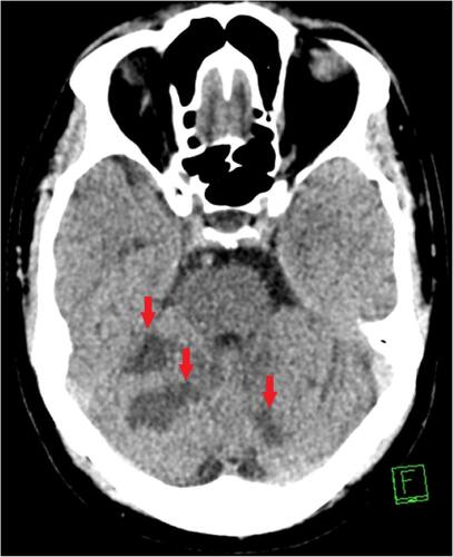 Figure 1 An axial view of a non-contrast computed tomography scan showing multiple areas of acute and subacute ischemic strokes in different territories.