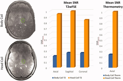 Figure 7. Comparison of mean SNR measured in the thalamus (a, green circle) using volume body coil or head coil. (b) Comparison using T2wFSE planning images is shown in 3 planes, and for thermometry images in the axial plane. Mean SNR was normalized to the maximum SNR across volunteers for each respective sequence type. Data are mean SNR ± standard deviation. For T2wFSE SNRnorm = 0.20 ± 0.05, 0.26 ± 0.03, and 0.25 ± 0.05 for the volume body coil, and SNRnorm = 0.95 ± 0.20, 1 ± 0.38, 0.85 ± 0.10 for the head coil, in the axial, sagittal, and coronal planes, respectively. For the thermometry sequence SNRnorm = 0.23 ± 0.04 for the volume body coil and SNRnorm = 1 ± 0.42 for the head coil.