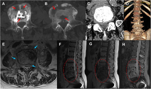 Figure 3 CT before revision surgery showed multiple bone destructive changes (red arrow) of L4 and L5 vertebra (A–D). MRI before revision surgery showed intraspinal and paravertebral abscess formation (blue arrow) of the L4 vertebra, hypointense signal (red circle) on T1WI of L3, L4, and L5 vertebra, mixed-signal intensity (red circle) on T2WI, and hyperintense signal (red circle) on FS-T2WI (E–H).