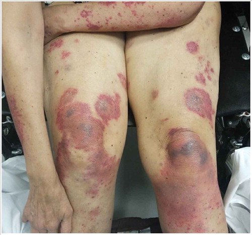 Figure 3. Vialoceous skin rashes on bilateral upper and lower extremities.