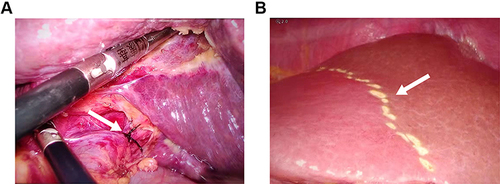 Figure 4 Intraoperative photographs during stage I surgery. (A) Selective isolation and ligation of the right portal vein (white arrow); (B) Ischemic line (white arrow) of the right liver.